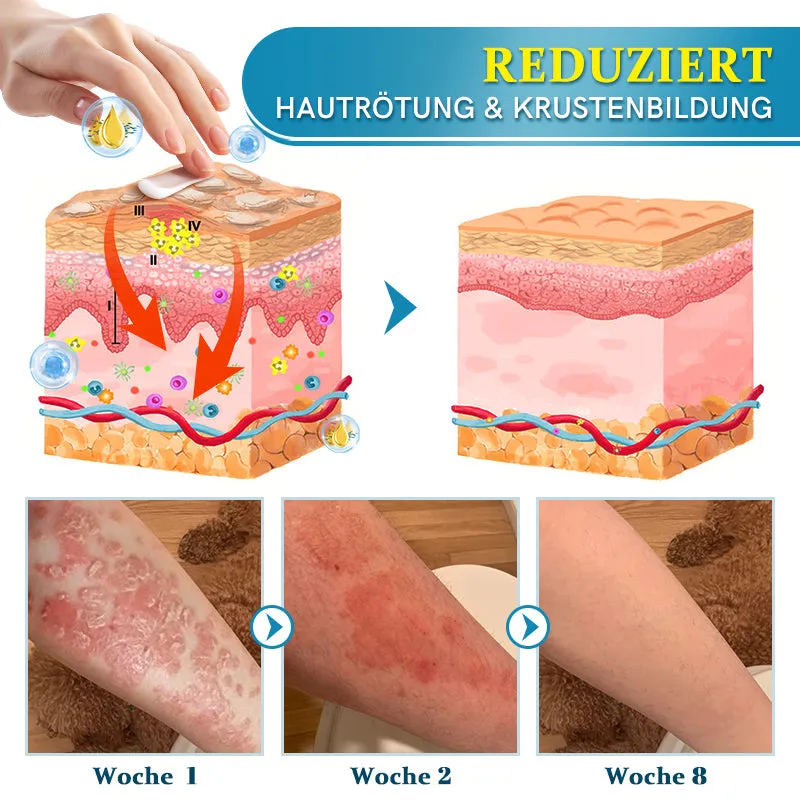 Furzero Multi-Symptom Psoriasis Behandlungscreme