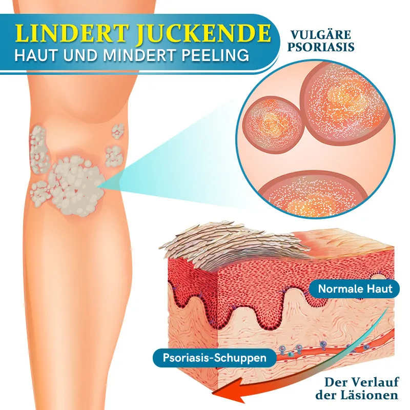 Furzero Multi-Symptom Psoriasis Behandlungscreme