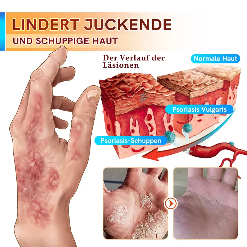 Furzero PsoriaCare Psoriasis-Behandlungscreme